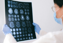 Mais de meio milhão de mortes por AVC podem estar ligadas às mudanças climáticas