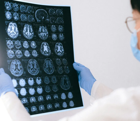 Mais de meio milhão de mortes por AVC podem estar ligadas às mudanças climáticas